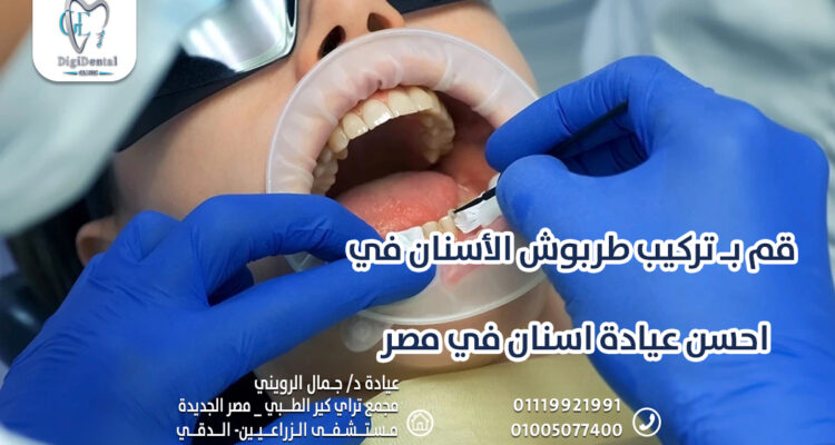 قم بـ تركيب طربوش الأسنان في احسن عيادة اسنان في مصر