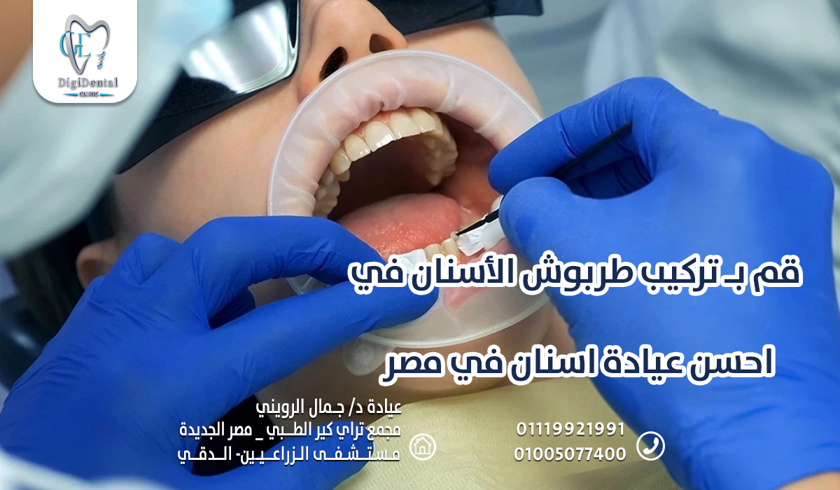 قم بـ تركيب طربوش الأسنان في احسن عيادة اسنان في مصر